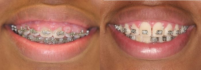 gums growing over braces