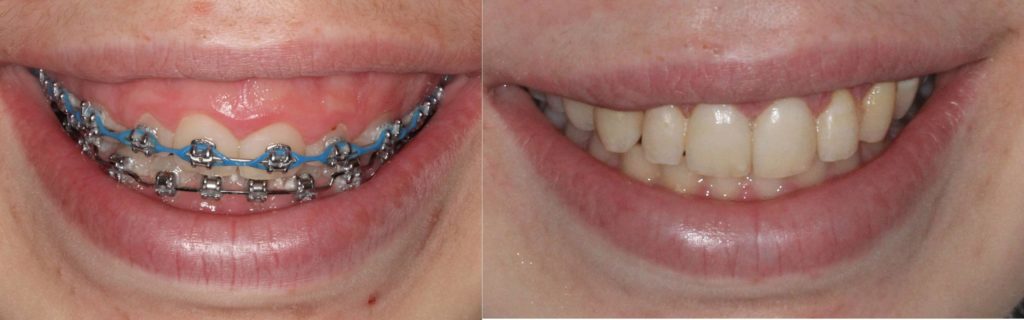 While wearing braces swollen gums How to