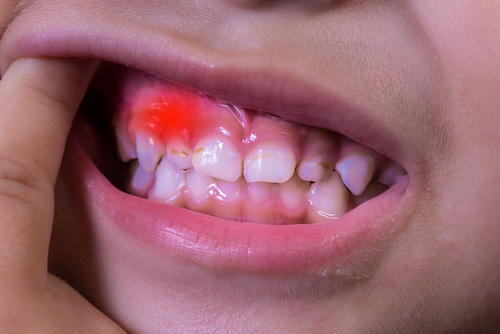 Gum Disease in child