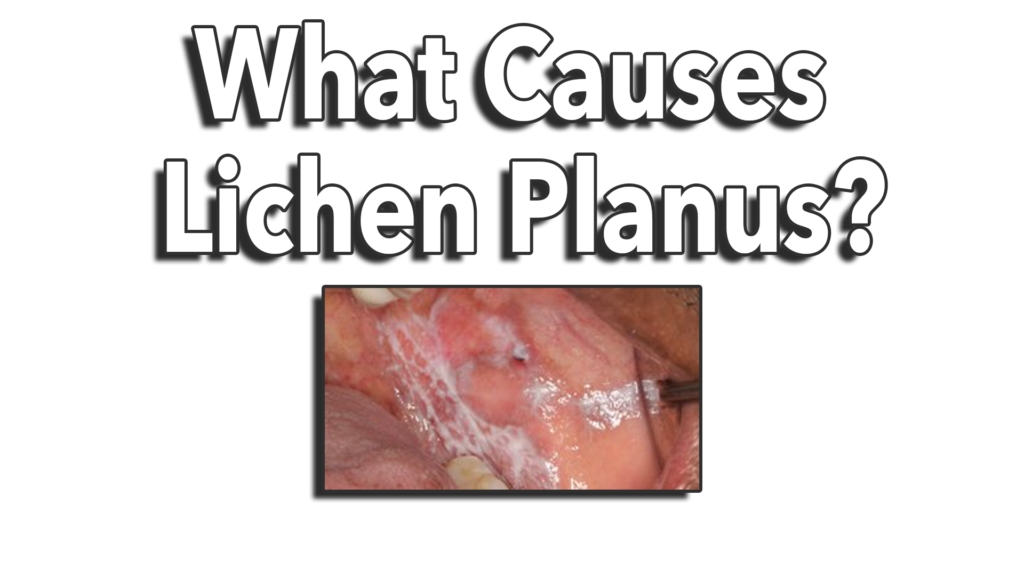 what causes lichen planus