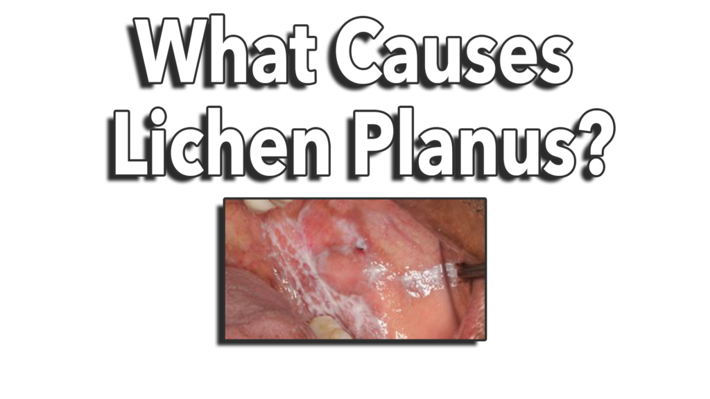 What Is Oral Lichen Planus