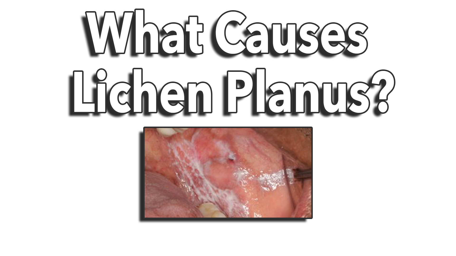 hpv virus cause lichen planus