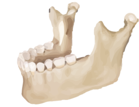 Bone-graft-in-Southfield-MI-11