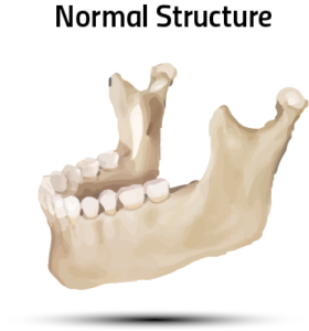 bone-graft-in-southfield-mi