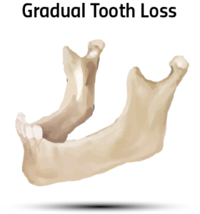 bone-graft-in-wayne-county-mi