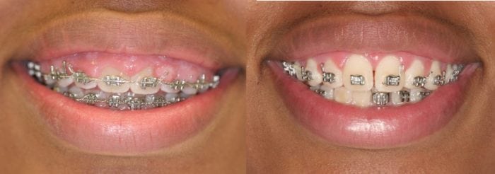 Gums Growing Over Braces • Nemeth And Katranji 