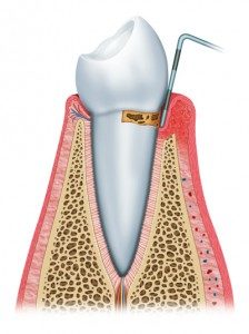 gingivitis-treatment-224x300