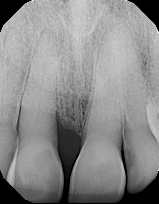LANAP-X-RAY-AFTER-BONE-GROWTH-1 After bone growth