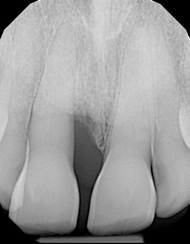 LANAP-X-RAY-BEFORE-1 Before bone growth