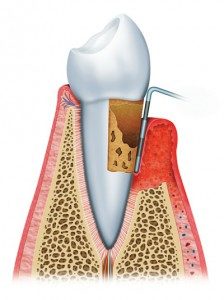 Periodontal-Disease-224x300-224x300