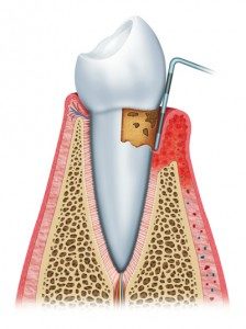 periodontitis-224x300