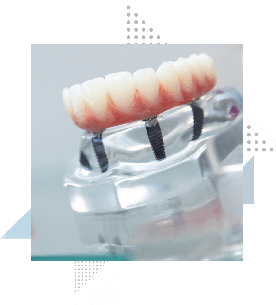 all-on-4-dental-implants-model