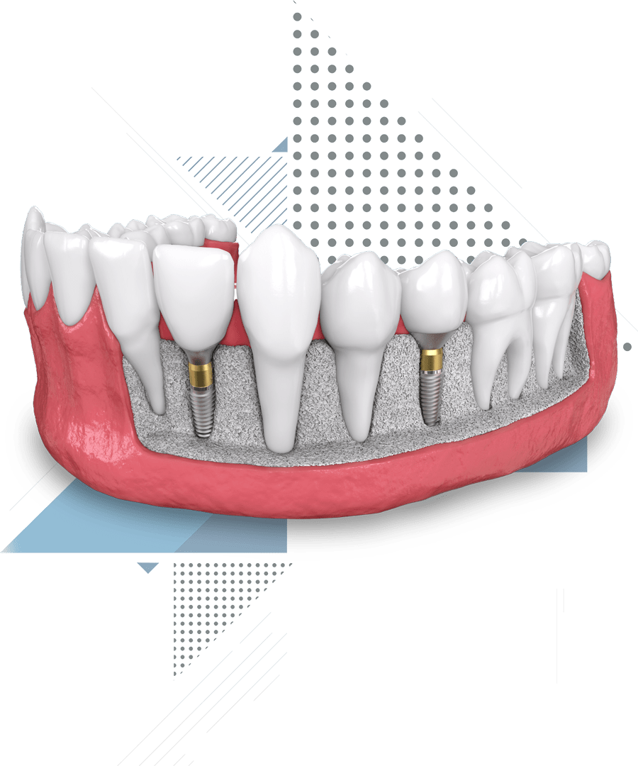 bone-grafting-model