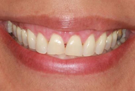 crown-lengthening-01-after crown-lengthening-01-after