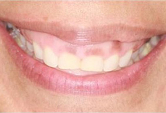 crown-lengthening-01-before crown-lengthening-01-before
