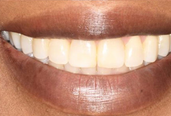 crown-lengthening-02-after crown-lengthening-02-after