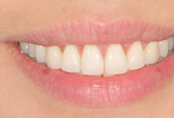 crown-lengthening-03-after crown-lengthening-03-after