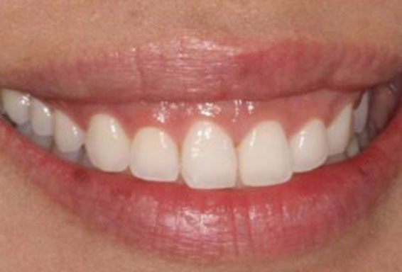crown-lengthening-03-before crown-lengthening-03-before