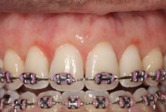 crown-lengthening-04-after crown-lengthening-04-after