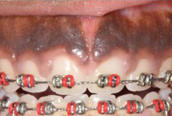 crown-lengthening-04-before crown-lengthening-04-before