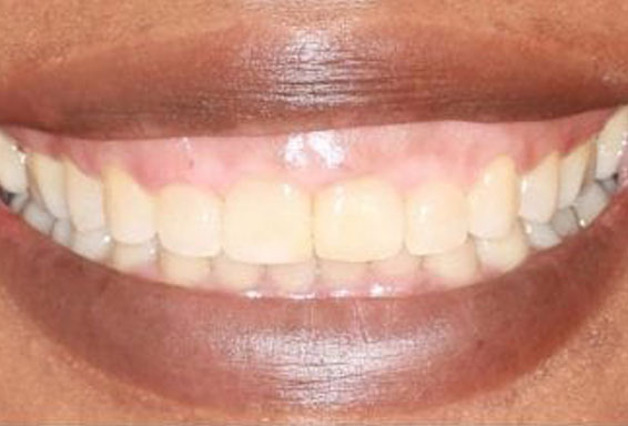 crown-lengthening-before-2 crown-lengthening-before-2