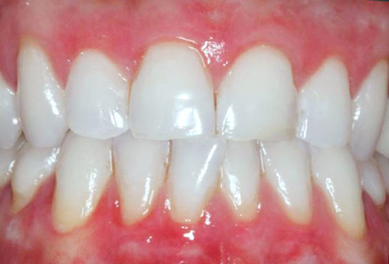 dark-gum-treatment-01-after dark-gum-treatment-01-after