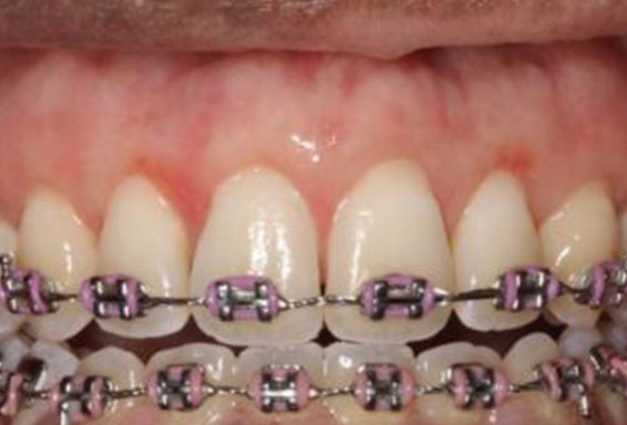 dark-gum-treatment-02-after dark-gum-treatment-02-after