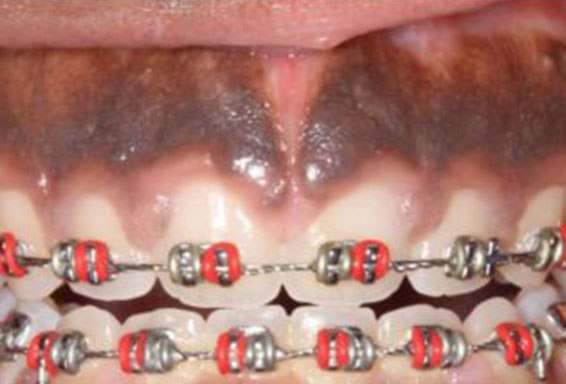 dark-gum-treatment-02-before dark-gum-treatment-02-before
