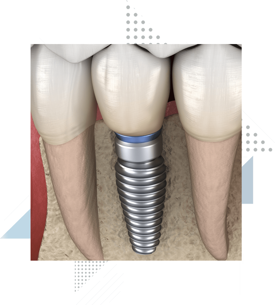 dental-implant-model-1