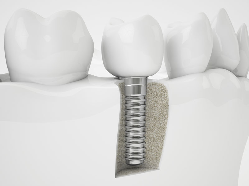dental-implant-model-2