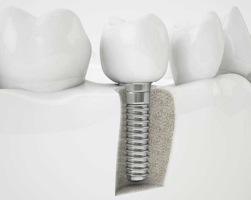 dental-implant-model