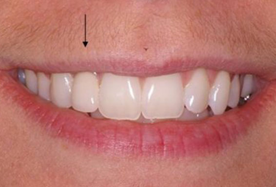 dental-implants-01-after