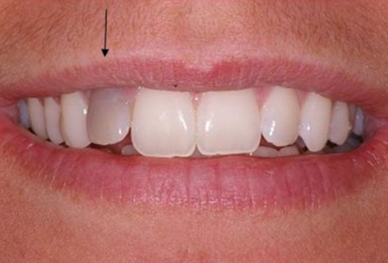 dental-implants-01-before