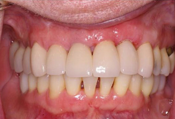 dental-implants-02-after