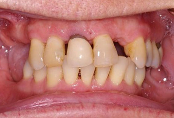 dental-implants-02-before