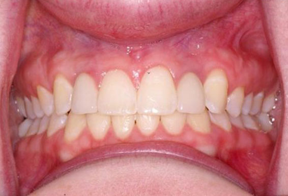 dental-implants-after dental-implants-after
