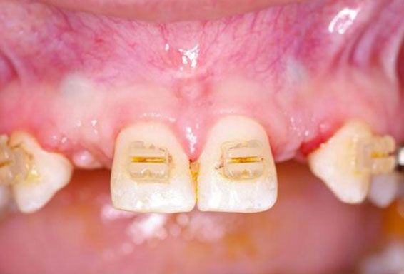 dental-implants-before