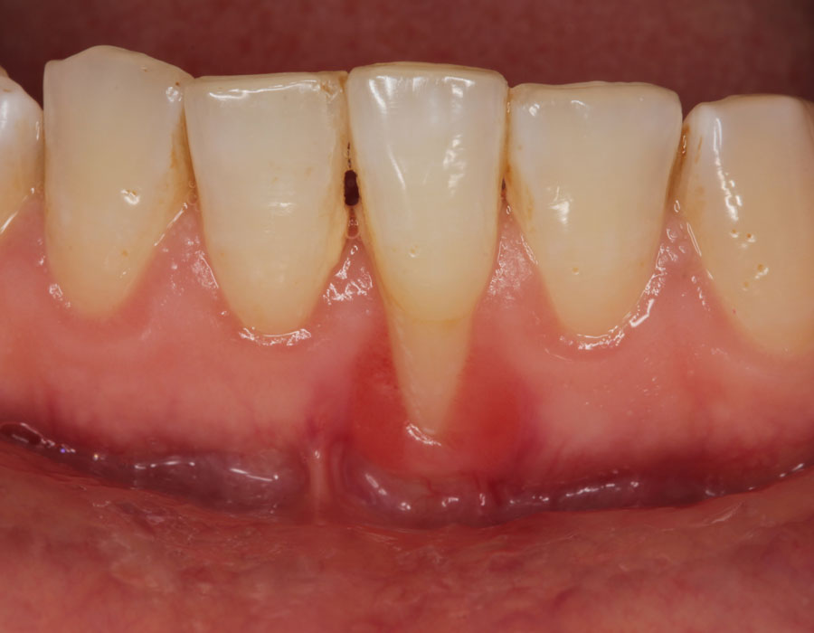 dental-patient-in-need-of-soft-tissue-grafting dental-patient-in-need-of-soft-tissue-grafting