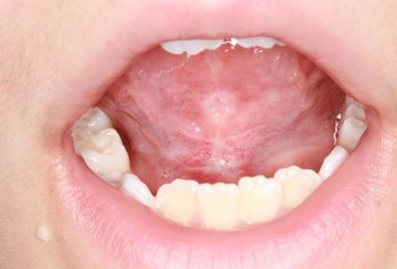frenectomy-after-1 frenectomy-after-1
