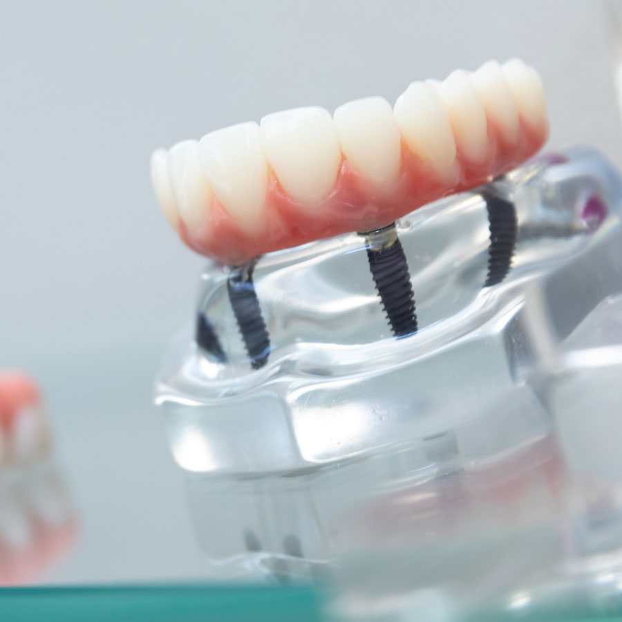 full-arch-dental-implants-model full-arch-dental-implants-model