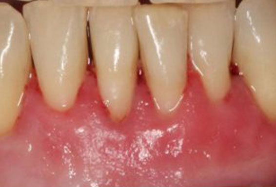 gum-recession-01-after gum-recession-01-after
