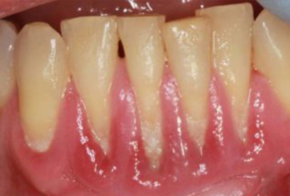 gum-recession-01-before gum-recession-01-before