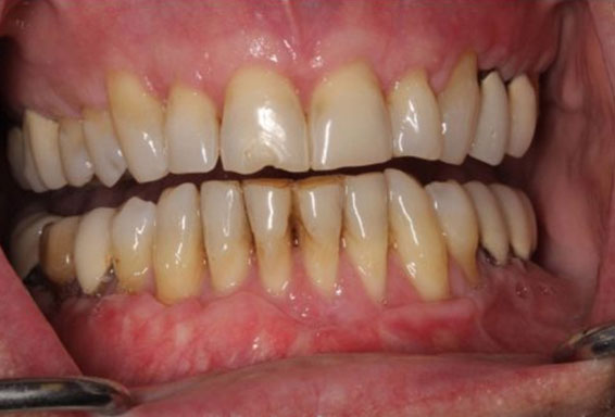 gum-recession-02-after gum-recession-02-after