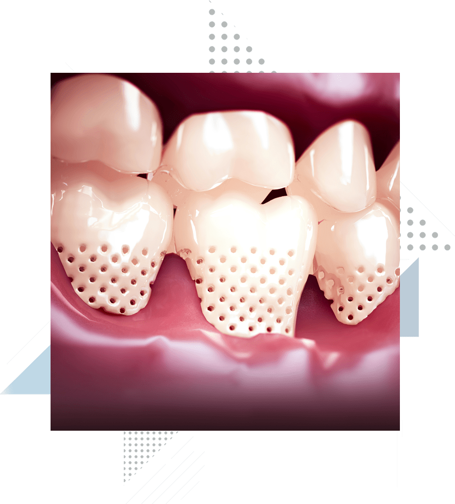 gum-recession-graphic gum-recession-graphic