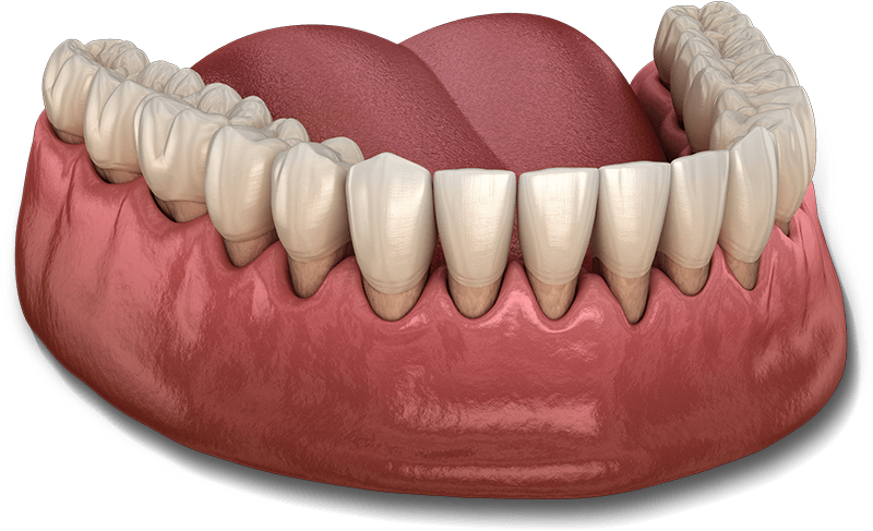 gum-recession-model