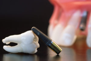 Dental implants