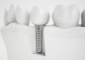 dental implants