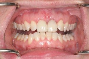 labial-Frenectomy-after labial-Frenectomy-after