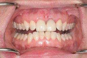 labial-Frenectomy-after