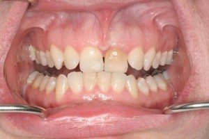 labial-Frenectomy-before